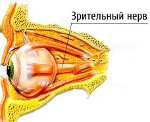 Ретробульбарный неврит зрительного нерва при рассеянном склерозе, лечение. 