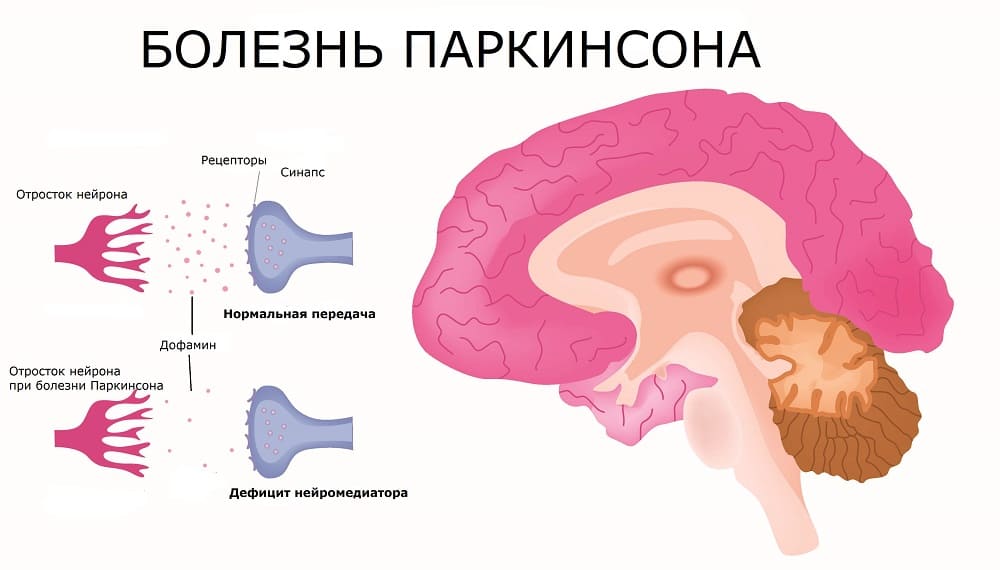 Симптомы, лечение и причины болезни Паркинсона 