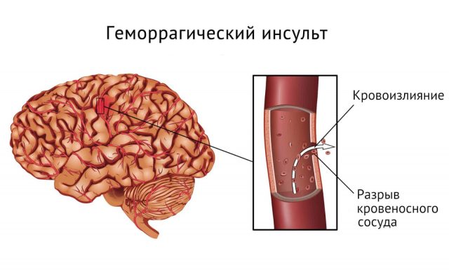 Симптомы, опасность и лечение отека мозга при инсульте 