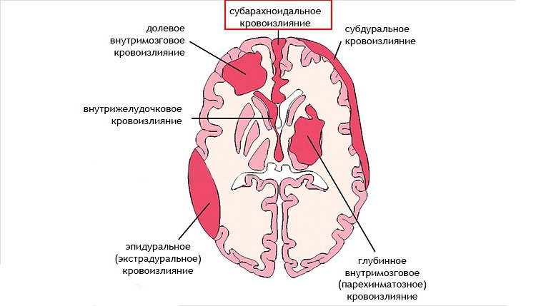 Субарахноидальное кровоизлияние 