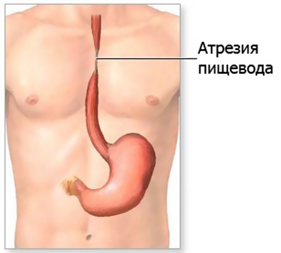 Что такое атрезия пищевода и особенности её лечения 