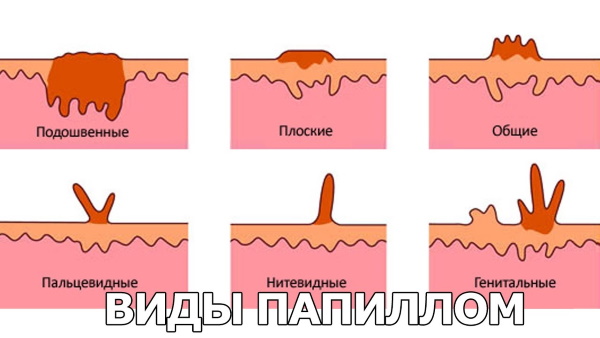 18 эффективных средств от бородавок и папиллом, которые можно купить в аптеке 