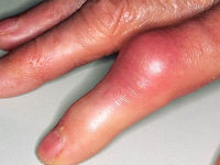 7 причин отёка (опухоли) пальца на руке, что делать? 