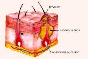 Абсцесс кожи, фурункул и карбункул (фурункулез, гнойник кожи, чирей, чирий, чиряк, нарыв, веред, воспаление) 