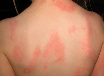 Аллергическая крапивница — симптомы и лечение 
