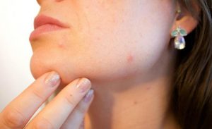 Аллергические прыщи на лице: причины и лечение 
