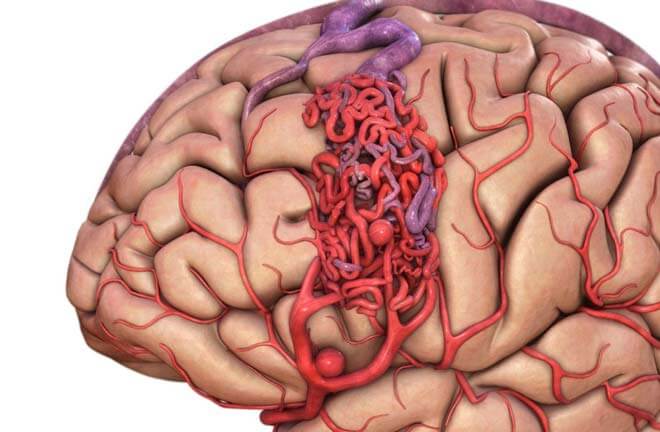Ангиома головного мозга: симптомы, лечение 