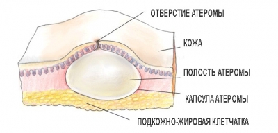 Атерома что это такое и как это лечить, в том числе без операции 