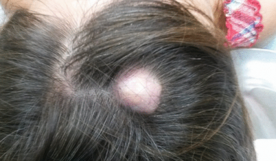 Атерома на голове: удаление с волосистой части кожи, причины, лечение 