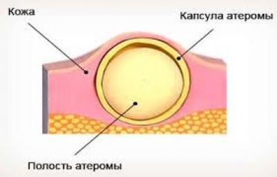 Атерома (закупорка сальной железы): причины возникновения и способы лечения 