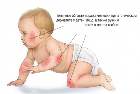 Атопический дерматит у детей — причины, симптомы, лечение и стадии развития 