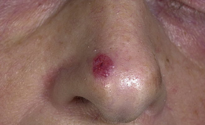Базалиома на носу: основные симптомы и способы лечения опухоли 