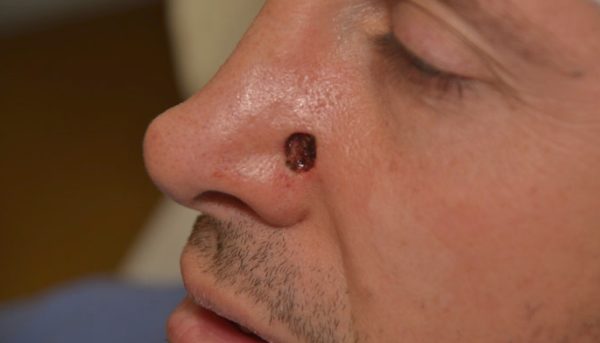 Базалиома носа: фото, особенности, внешний вид, похожие заболевания кожи. 