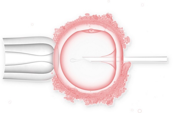 Что такое оплодотворение ИКСИ 