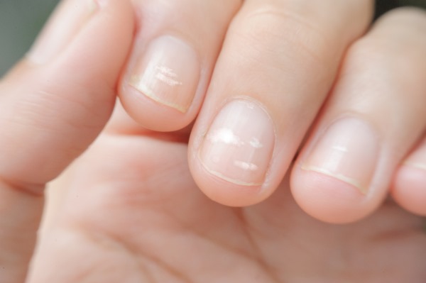 Белые пятна на ногтях пальцев рук. Что это значит, почему появляются. Причины возникновения у женщин, мужчин, детей. Диагностика и лечение 