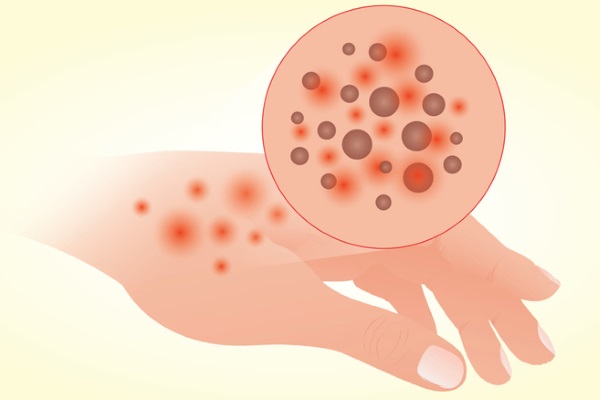 Чем можно быстро вылечить дерматит? 