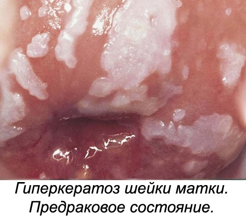 Чем опасен гиперкератоз плоского эпителия шейки матки 