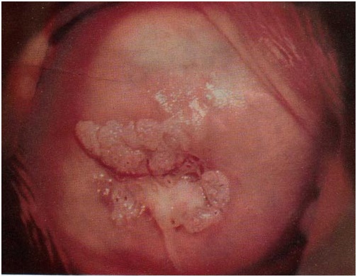 Чем опасны кондиломы на шейке матки и как их лечить 