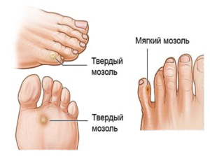 Чем помазать мозоль: лучшие народные средства и аптечные препараты 