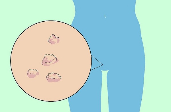 Что делать если появились папилломы на половых губах? 