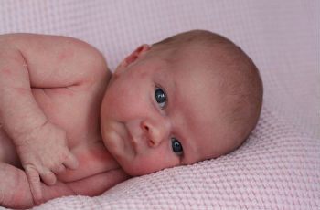 Что делать, если у новорожденного сухая кожа? 