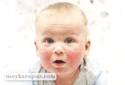 Что делать при сыпи на лице у новорожденного в 1 месяц 