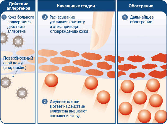 Что можно есть при аллергическом дерматите? 