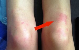 Что означают красные пятна на коленях? 