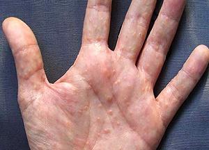 Что такое дисгидроз рук и как его вылечить? 