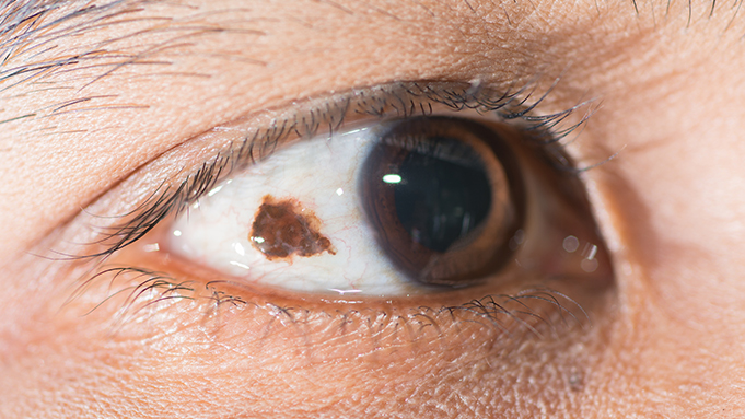 Что такое невус хориоидеи глаза: виды и лечение 