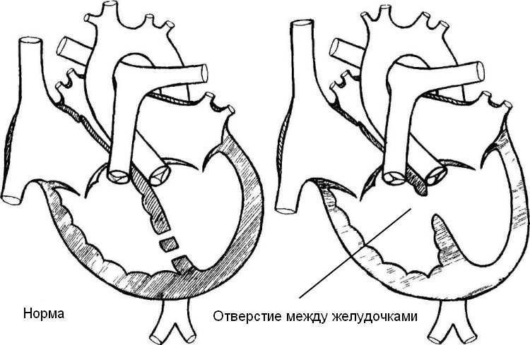 Дефект межжелудочковой перегородки у новорожденного 8345 1 13.11.2016 