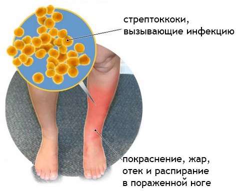 Что такое рожистое воспаление и как его лечить 