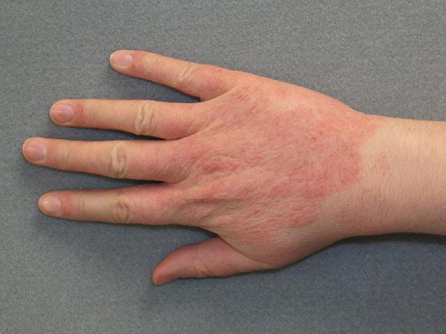Дерматит на руках: комплексное лечение заболевания 
