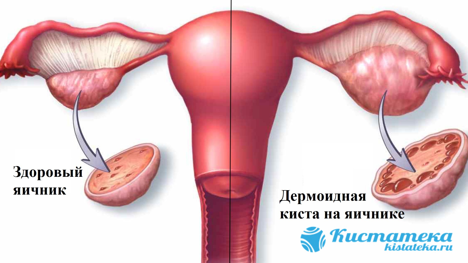 Дермоидная киста яичника — симптомы и лечение 