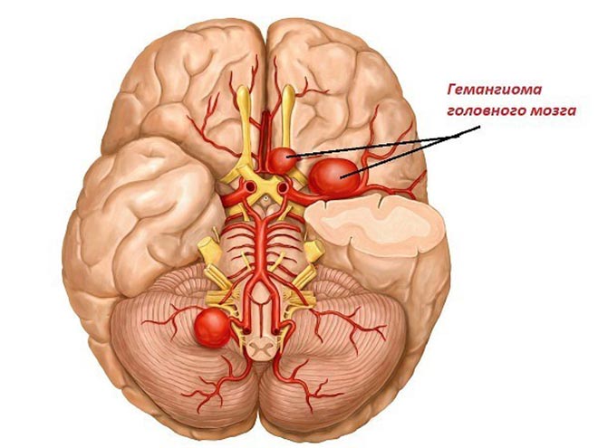 Гемангиома головного мозга: лечение, симптомы 