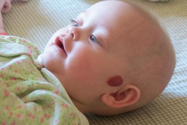 Гемангиома на голове у новорожденных лечение 