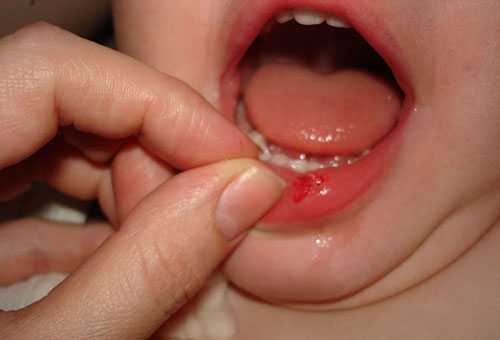 Если ребенок разбил губу – что делать родителям? 