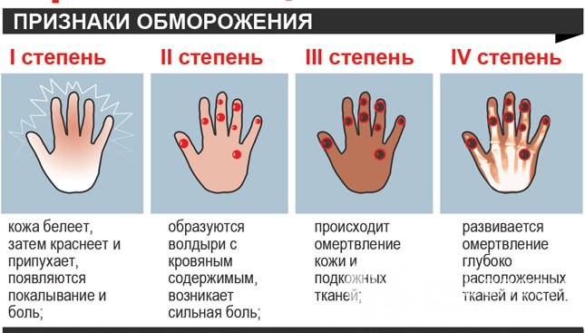 Как действовать при обморожении второй степени, важные особенности 