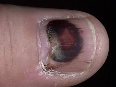 Как лечить ушиб ногтя на руке? 