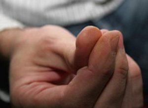 Лечение сосудов на пальцах рук от ломкости 