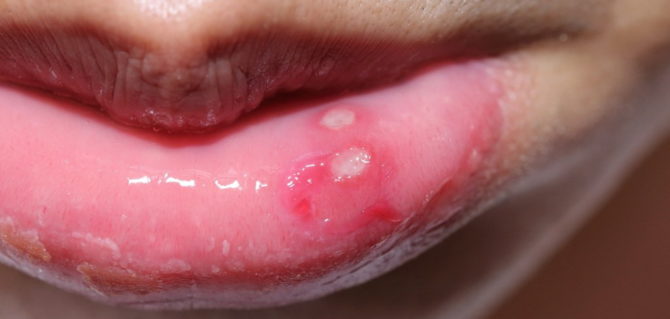 Причиной какого заболевания может оказаться белая болячка на губе и как ее лечить 