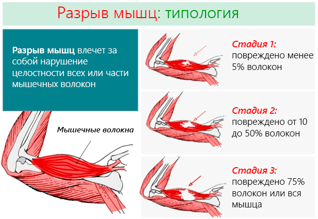 Разрыв мышцы 