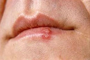Герпес на губах: симптомы и лечение 