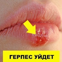 Герпетическая инфекция: лечение травами – за и против 