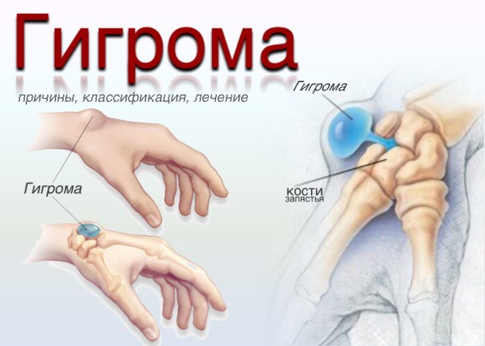 Гигрома (ганглий), пункция гигромы. 