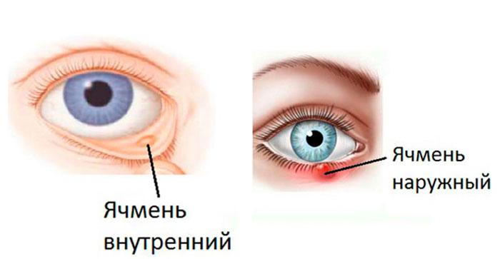 Глазные капли от ячменя на глазу — перечень, преимущества и противопоказания 