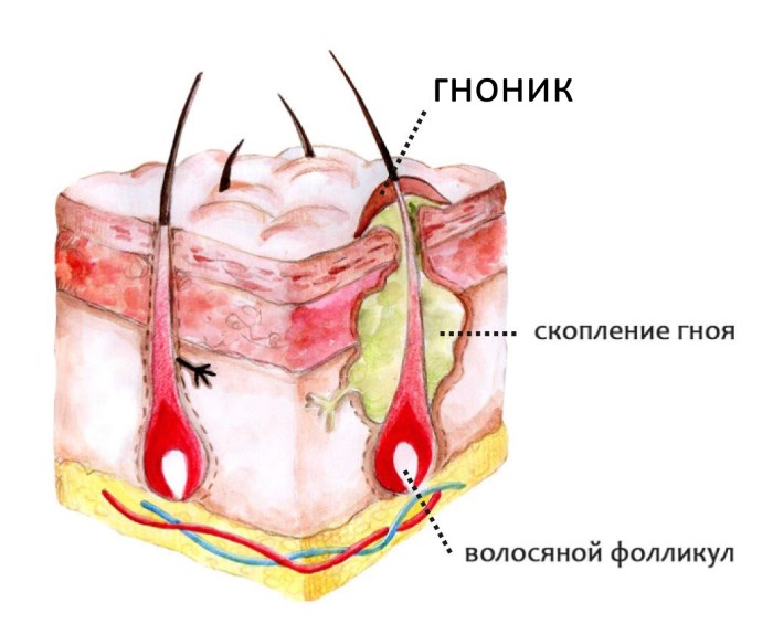 Гнойнички на голове: причины, симптомы и лечение 