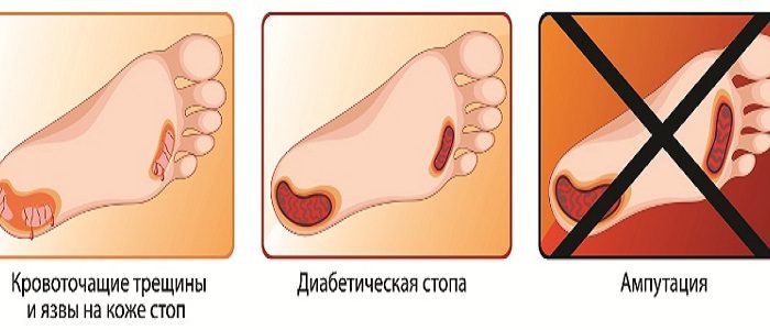 Гнойники и раны при сахарном диабете 