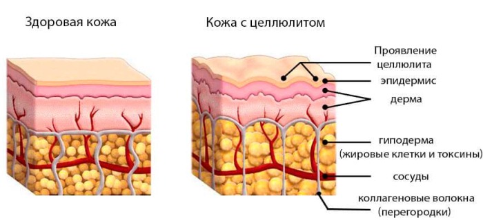 Горячая десятка самых эффективных кремов от целлюлита 