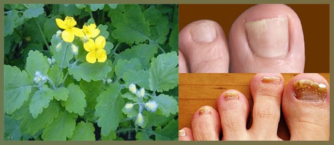 Чистотел от грибка ногтей на ногах – эффективное средство от природы 